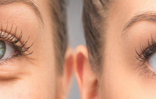 blepharoplasty