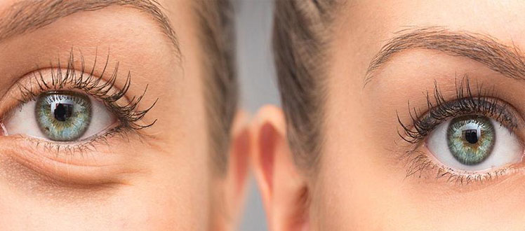 blepharoplasty