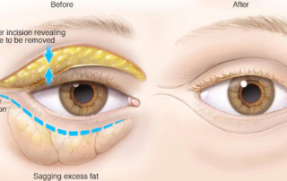 eyelids surgery tunisia