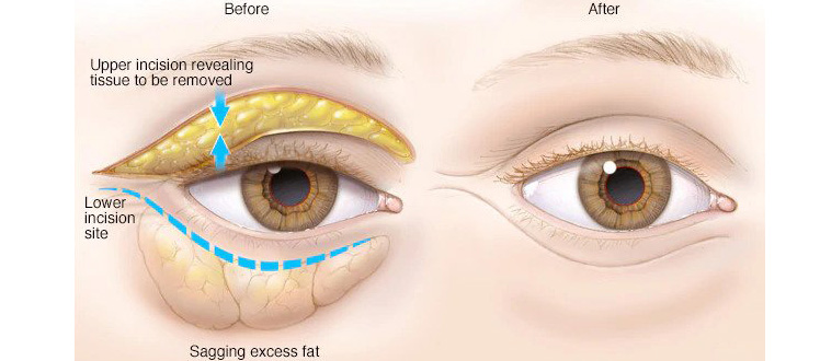 eyelids surgery tunisia