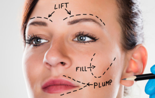 facelift