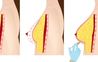 fat transfer breast tunis