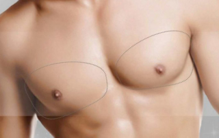 surgery men boobs tunisia