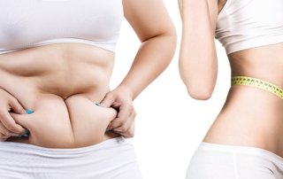 all about liposuction