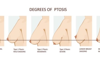 degrees ptosis breast lift tunisia