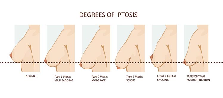 degrees ptosis breast lift tunisia