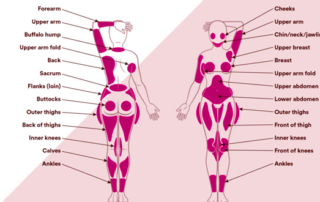 liposuction surgery area tunisia