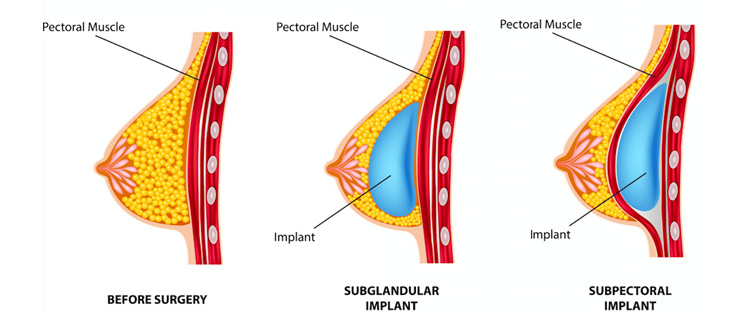 Breast implants placement