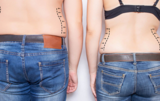 after liposuction
