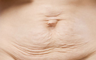 cosmetic surgery Post Pregnancy tunisia