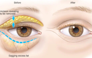 blepharoplasty eyelid upper lower tunisia