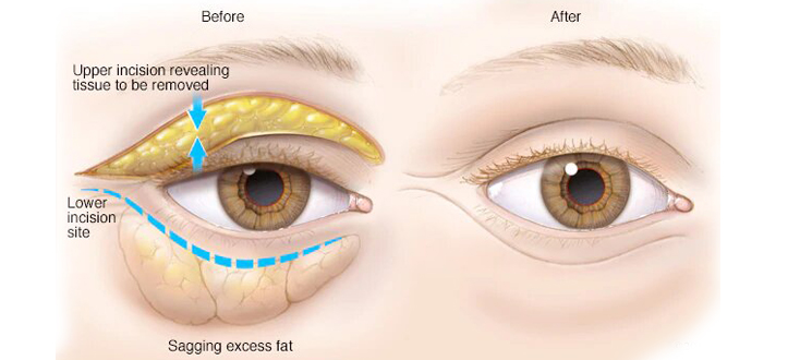 blepharoplasty eyelid upper lower tunisia