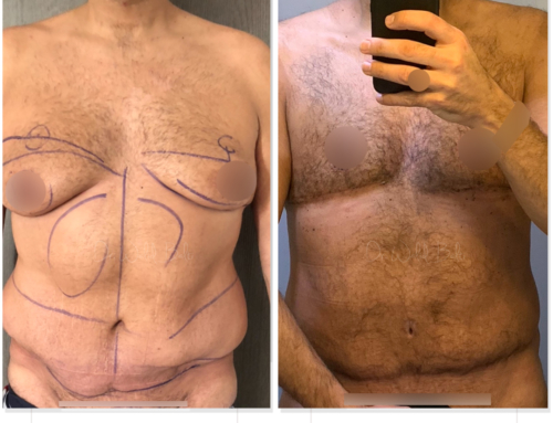 Liposuction, revision of tummy tuck performed by another surgeon and gynecomastia