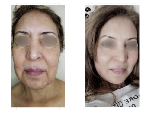 Facelift, facial fat grafting, neck lift and neck liposuction