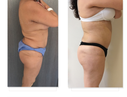 Revision of liposuction and brazilian butt lift performed by another surgeon