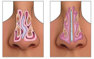 septoplasty tunisia