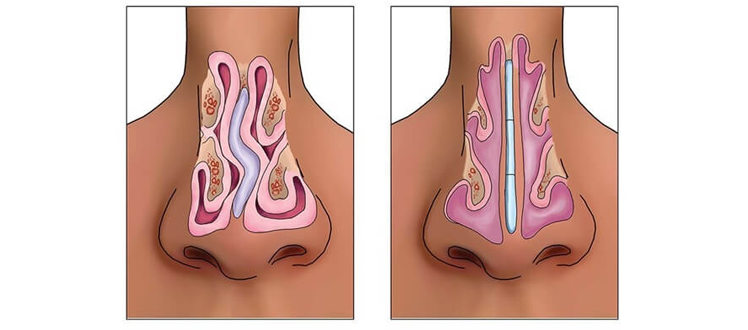 septoplasty tunisia