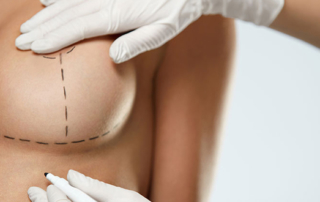 Breast lift or augmentation