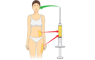 facial fat grafting in tunisia