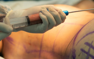lipo tunisia