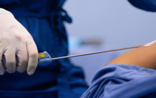 liposuction