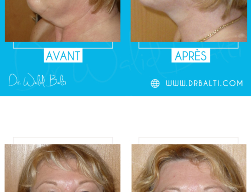 Facelift, neck liposuction & blepharoplasty