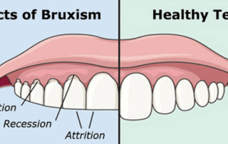 Is Botox really used to treat bruxism ?