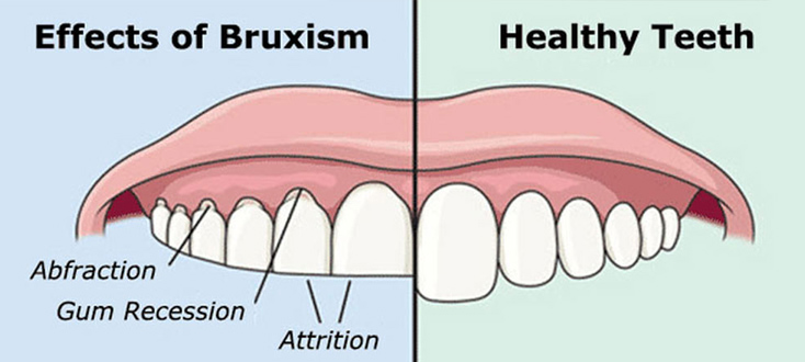 Is Botox really used to treat bruxism ?