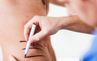 Cosmetic implants for men