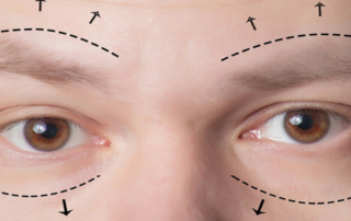 eyelid surgery tunisia