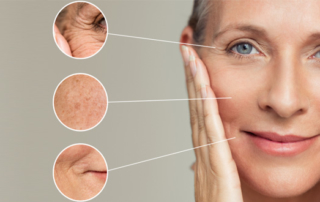 Treatment wrinkles facial volume loss
