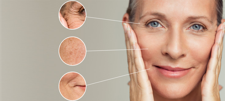 Treatment wrinkles facial volume loss