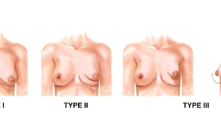Tuberous breasts stage