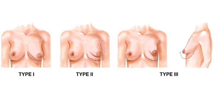 Tuberous breasts stage