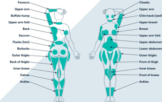 liposuction areas