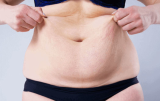 Different tummy tuck cases