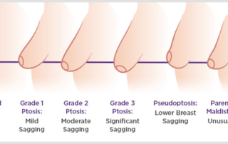 ptosis surgery breast lift