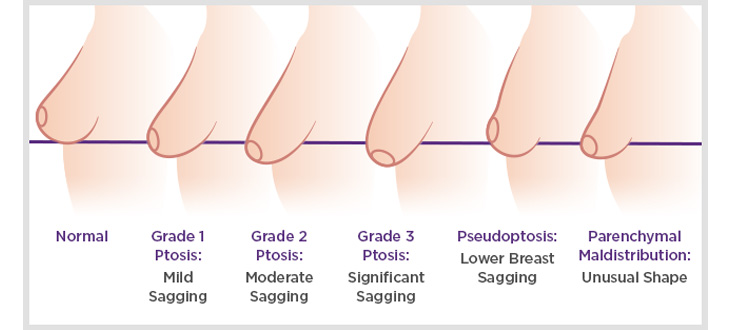 Artist's depiction of the breast ptosis grading system proposed by