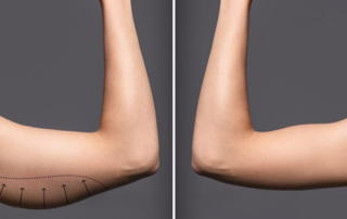 arm lift