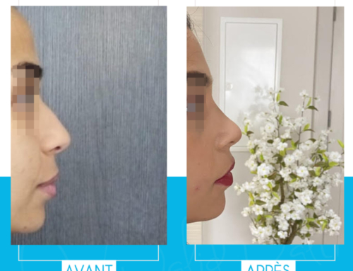 Rhinoplasty