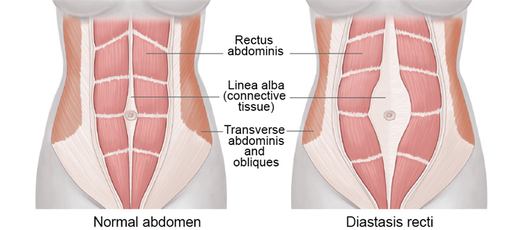 Everything you need to know about Diastasis recti