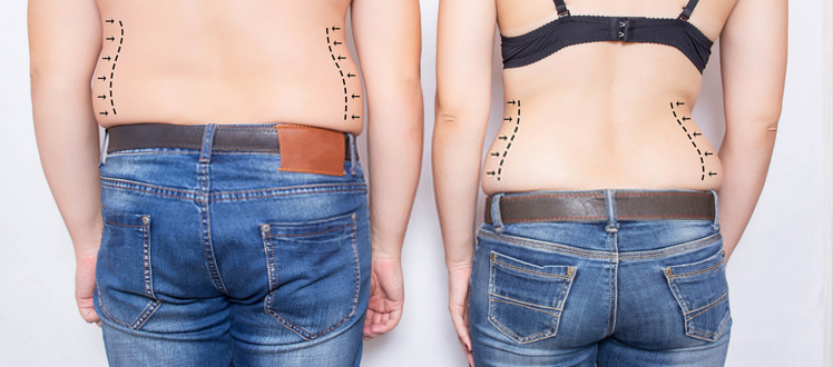 Is liposuction efficient against love handles ?