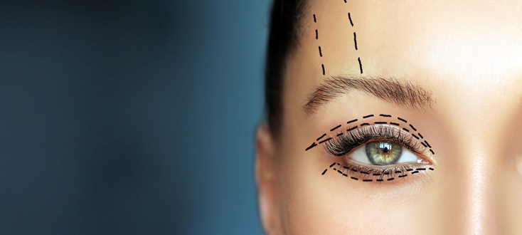 Answering frequently asked questions about blepharoplasty 