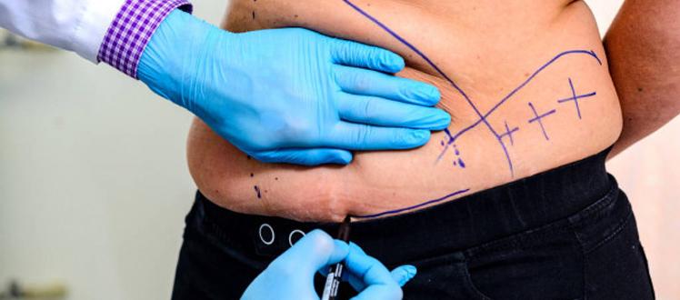 Is tummy tuck a viable option for you ?