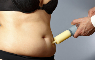 Liposuction : treatment areas and limits of the procedure