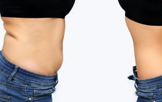 abdominoplasty-tunisia