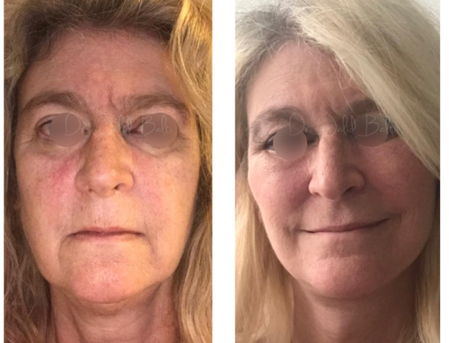 Facelift and fat grafting