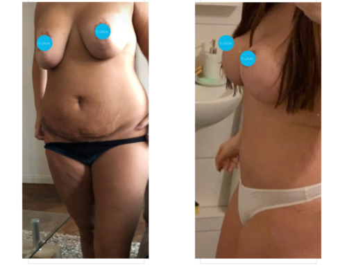 Breast revision surgery, tummy tuck and liposuction