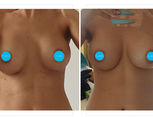 Breast implant revision