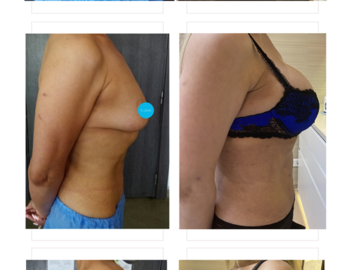 Breast augmentation & tummy tuck